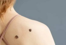 ¿Cómo prevenir el cáncer de piel?