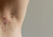 Claves para conocer más sobre la Hidradenitis